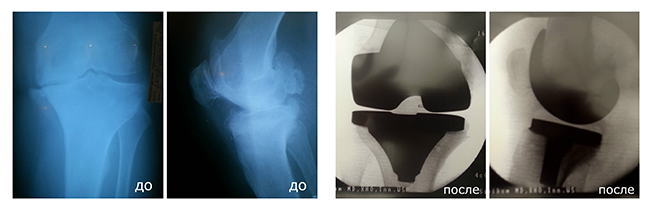 Эндопротезирование коленного сустава